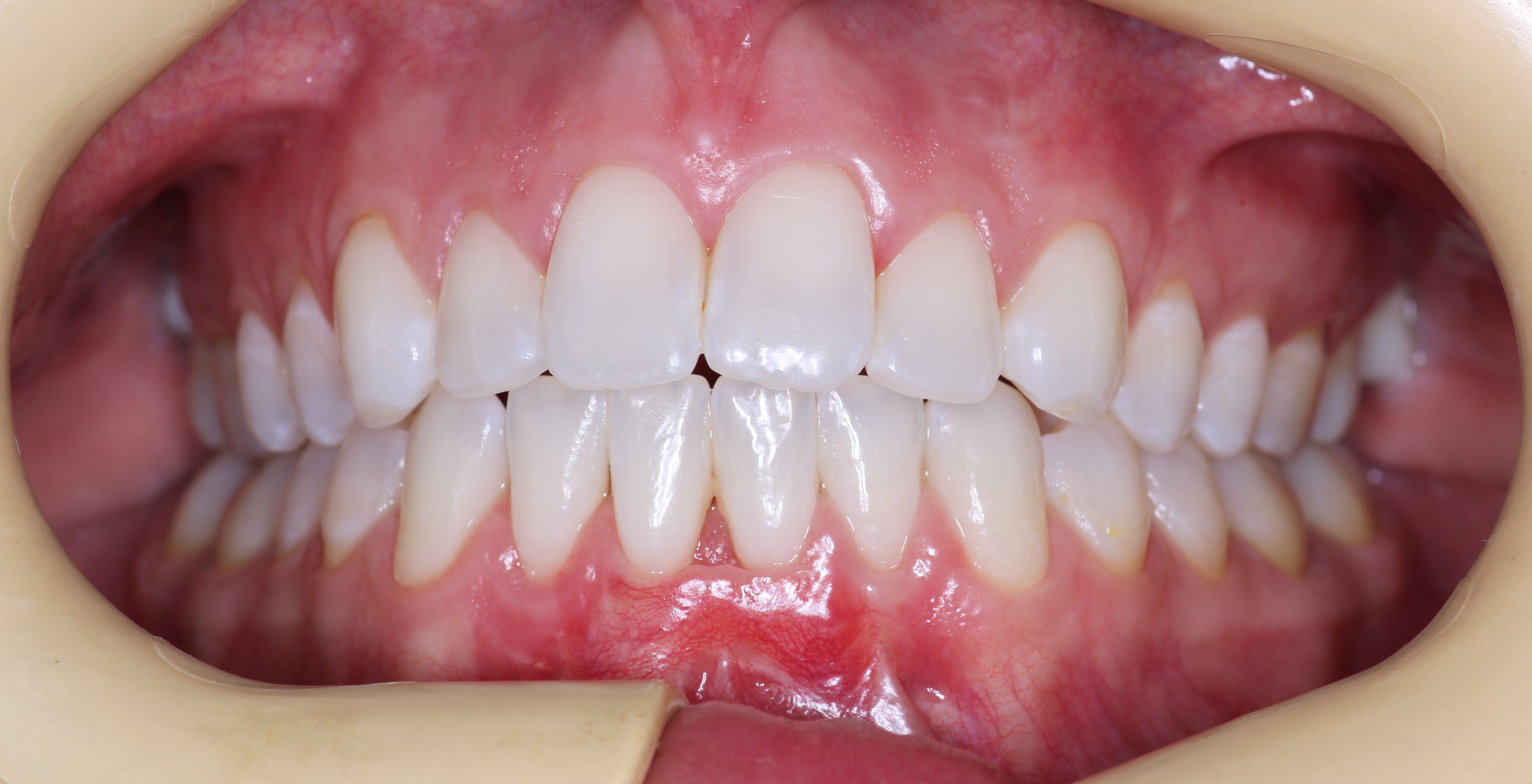 Gum Grafts - Dentist Fairview Mall North York