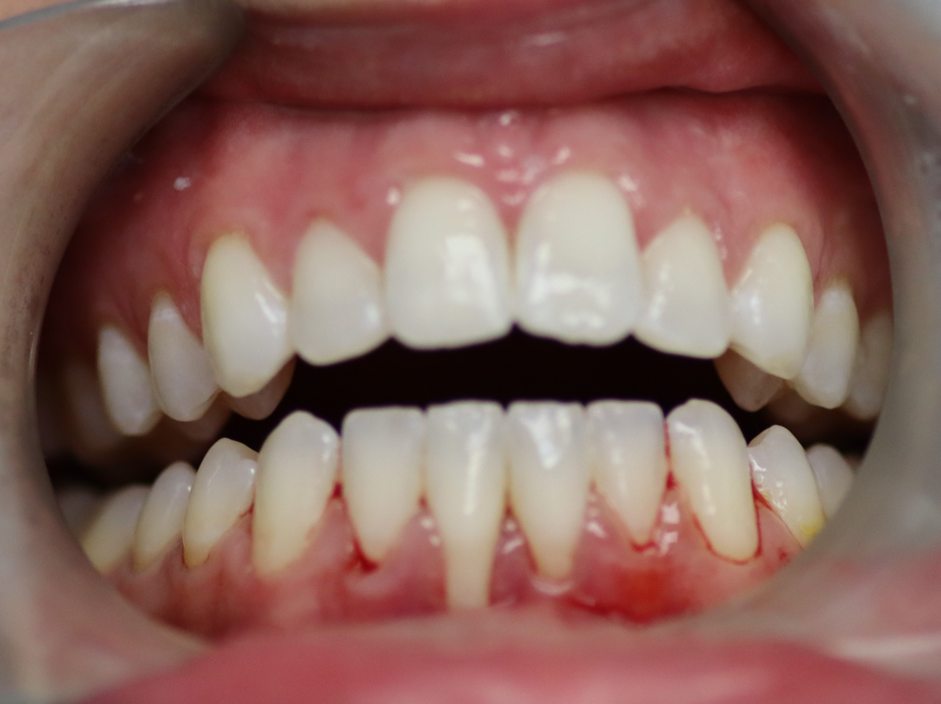 Gum Grafts - Dentist Fairview Mall North York