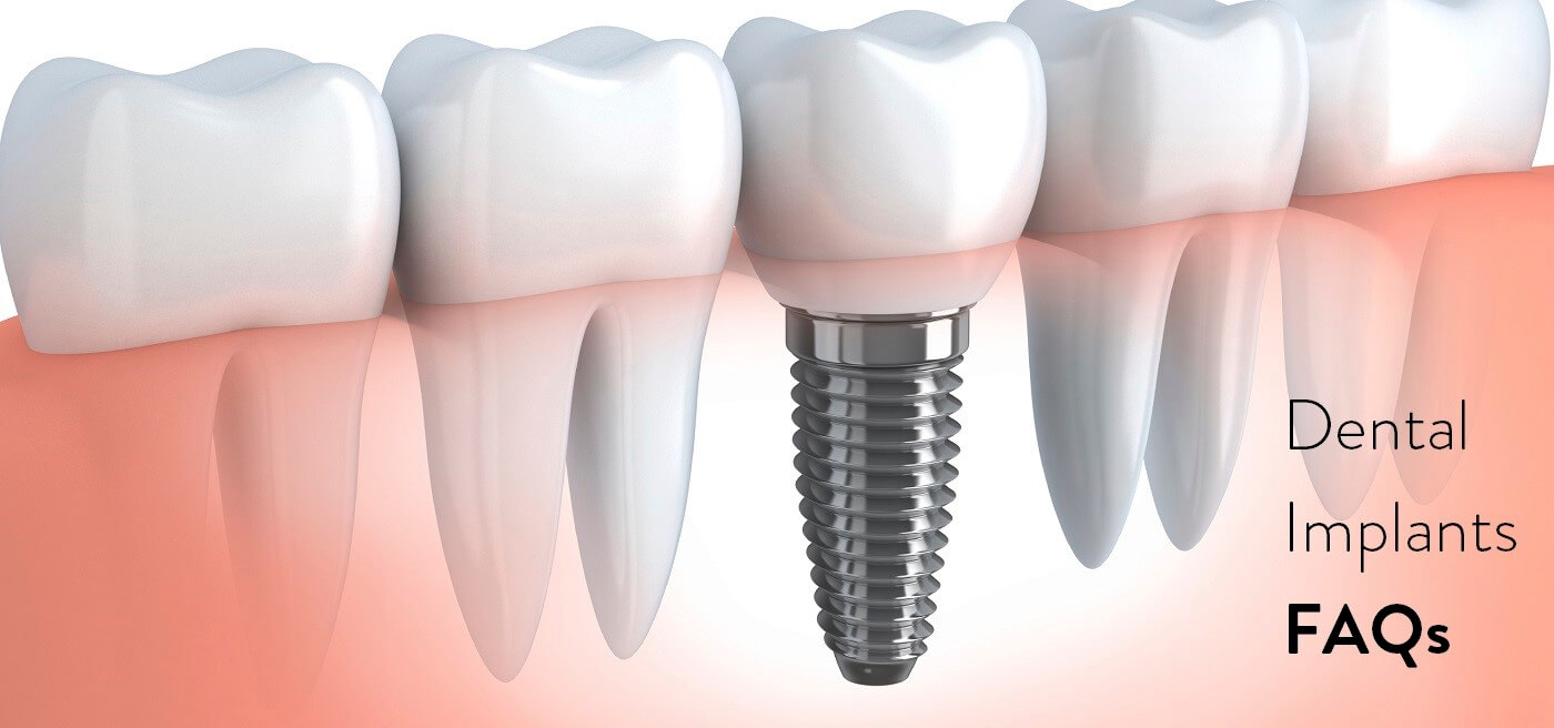 Dental Implants FAQs - Dentist Fairview Mall, North York
