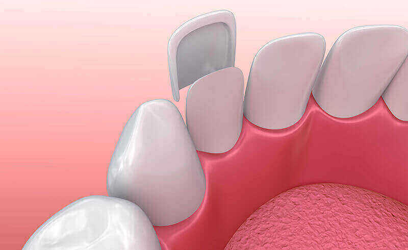 Veneers - Dentist Fairview Mall North York